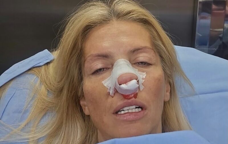 (ФОТО) Одборница „Крени-промени“ оперисана након напада Александра Шапића: Има преломе носа и вилице