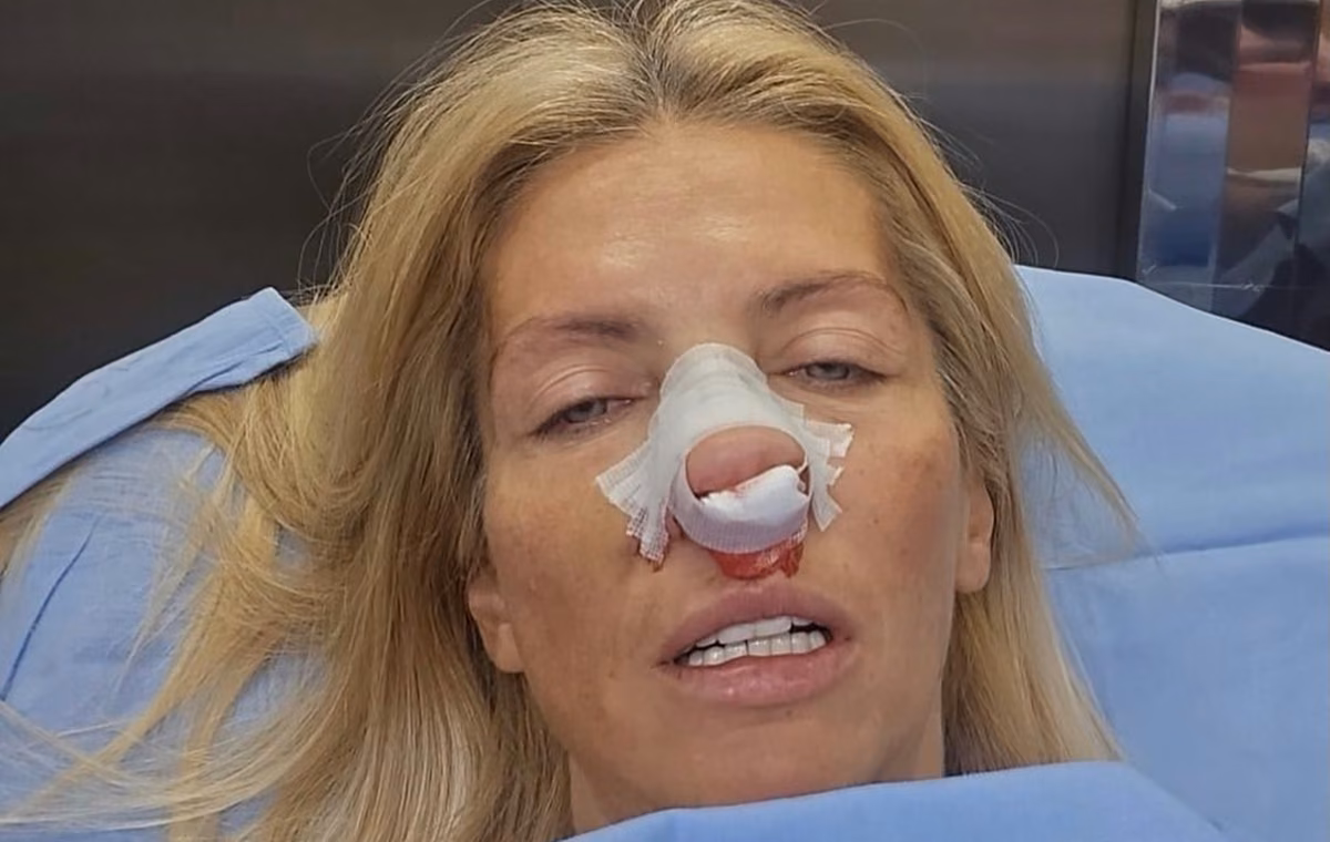 (ФОТО) Одборница „Крени-промени“ оперисана након напада Александра Шапића: Има преломе носа и вилице